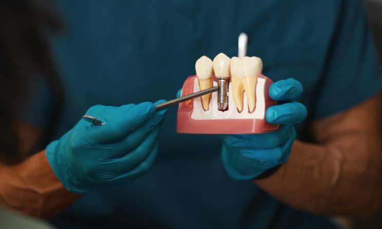 implant dentar
